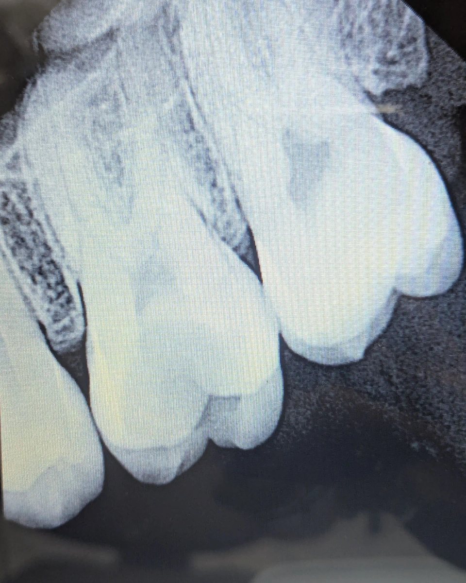 Restoration, follow-up radiograph