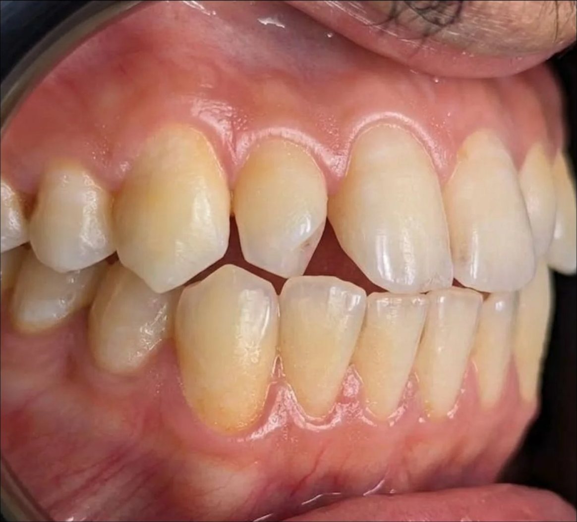 Composite bonding, kept natural