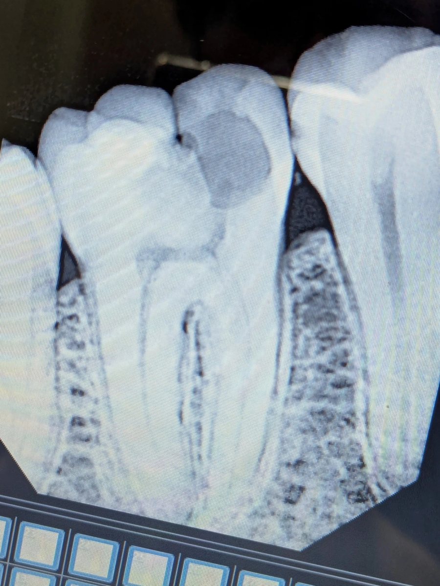 Pre-treatment radiograph