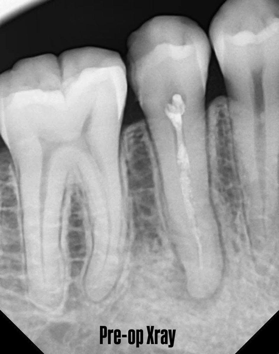 Retreatment, pre-op radiograph