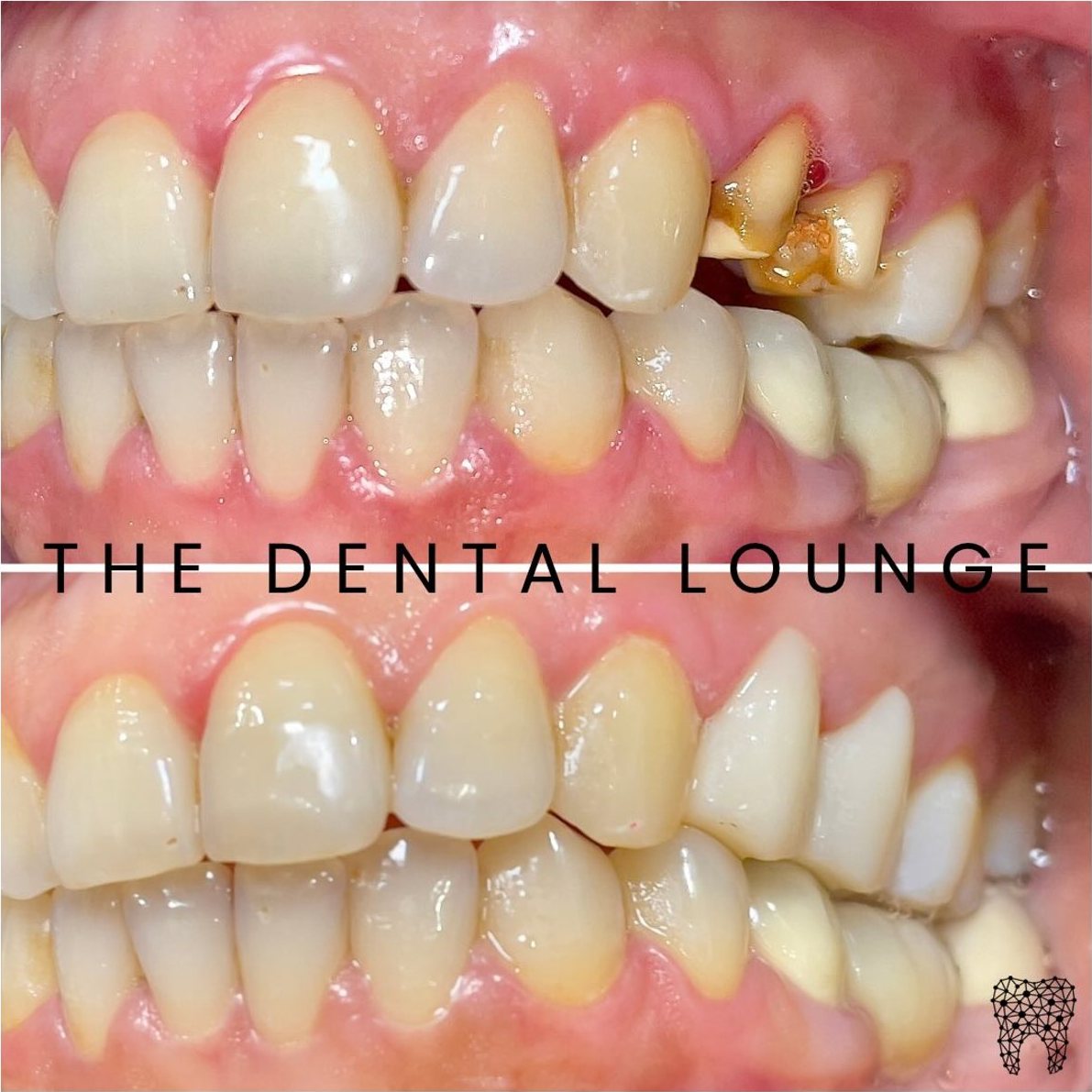 Before zirconia crowns