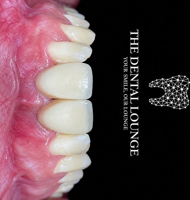 Anterior restoration, shade matched