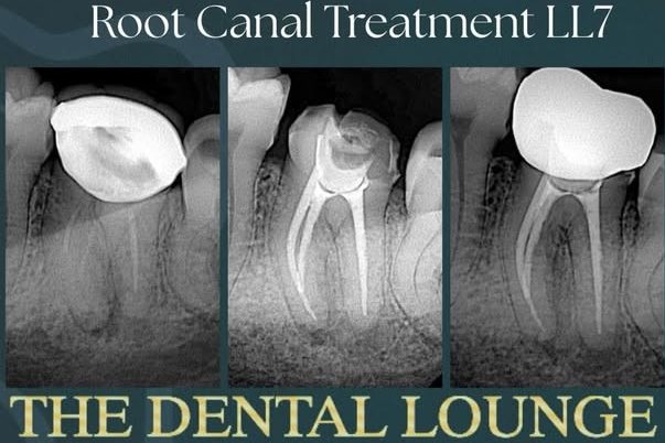Root canal treatment, LL7