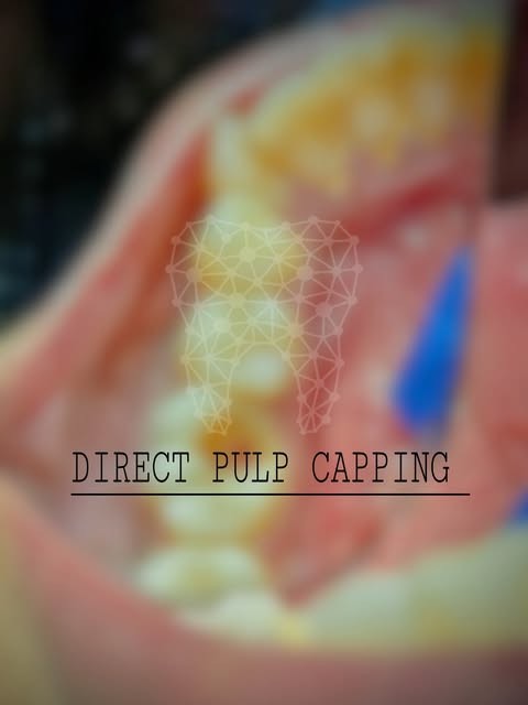 Direct pulp capping
