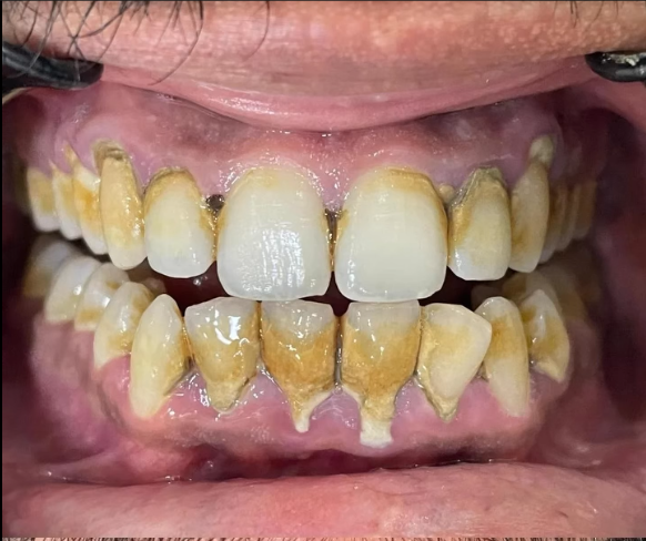 Before treatment