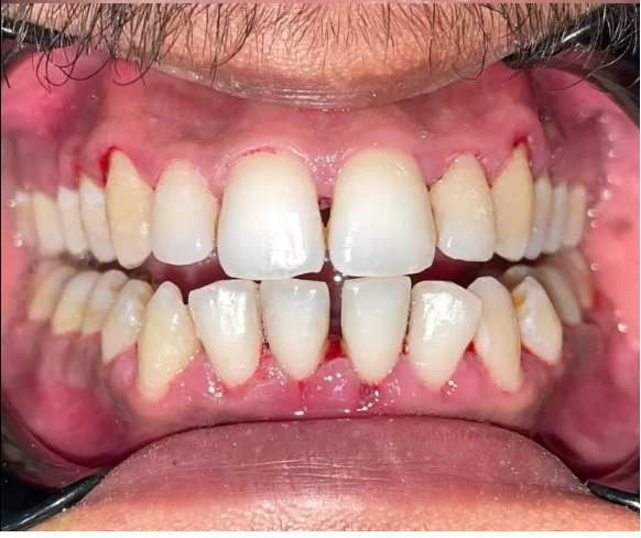 After treatment
