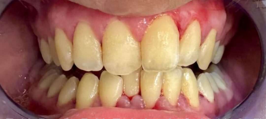 Before treatment