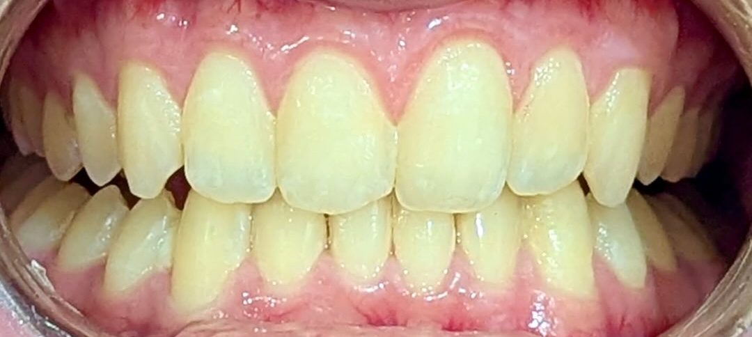After treatment