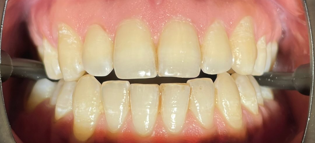 Before treatment