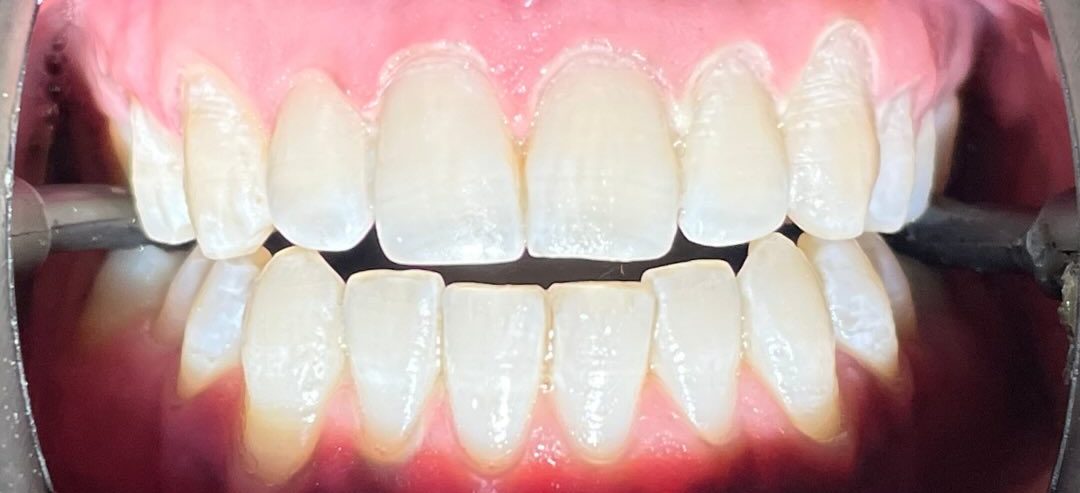 After treatment