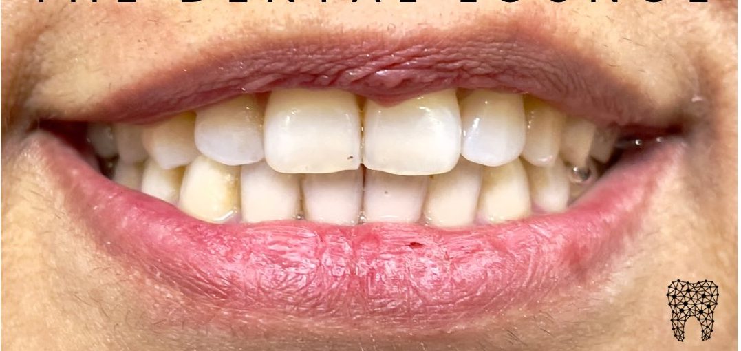After treatment