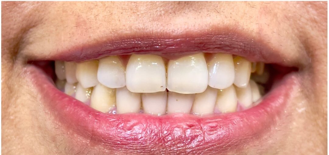 Before treatment