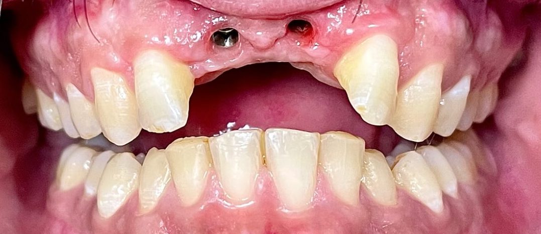 Before treatment