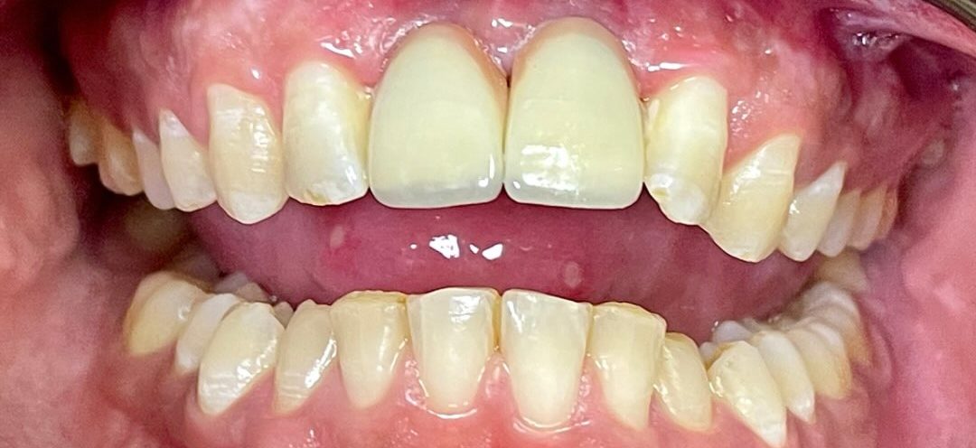 After treatment